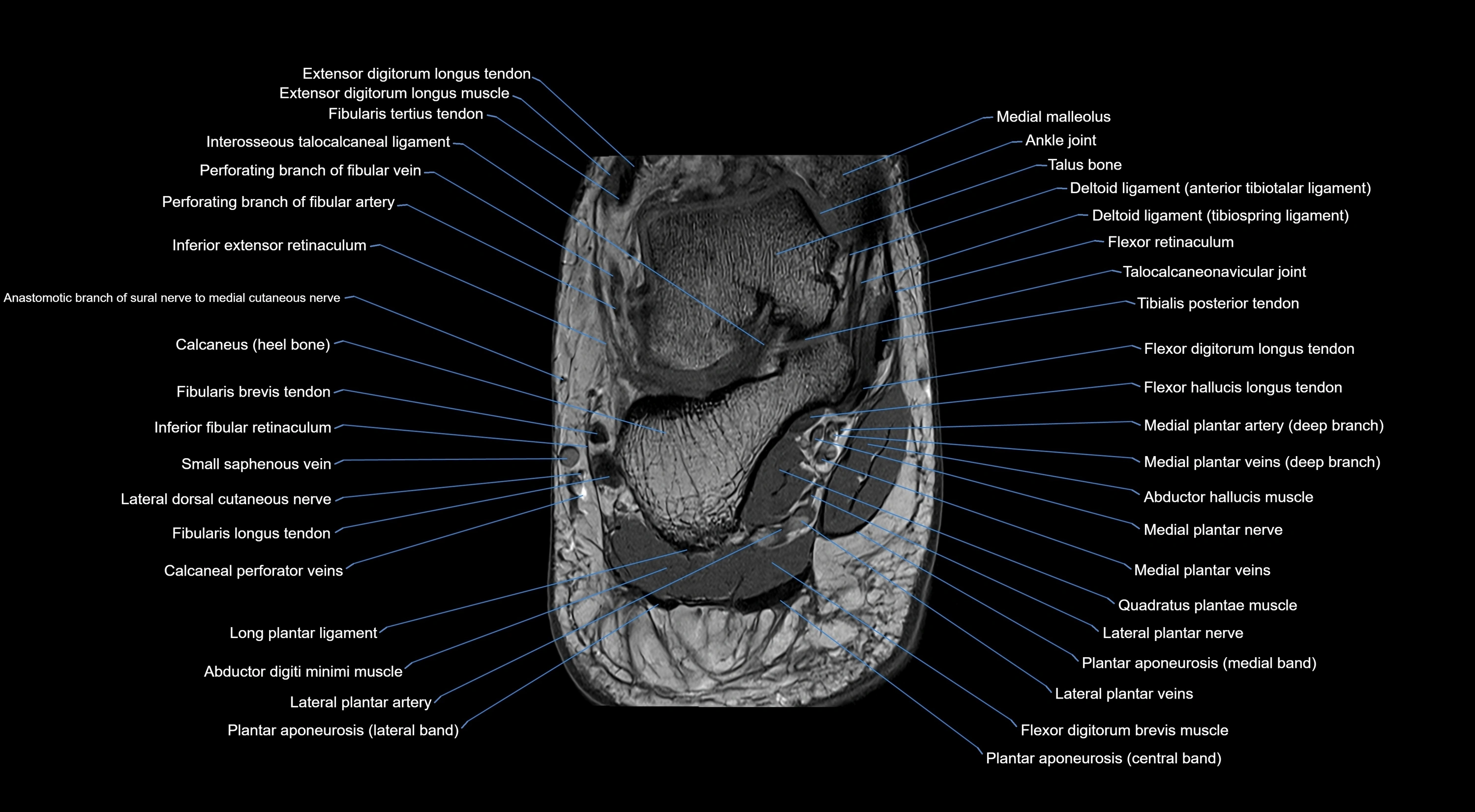 MRI mid foot coronal ligaments cross sectional anatomy 3T  radiology  image-img-00001-00046.webp